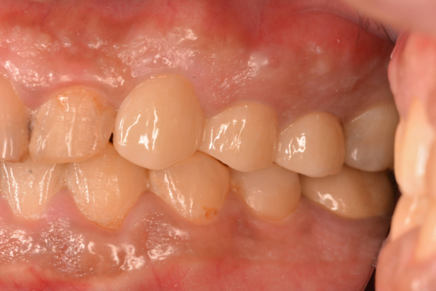 بعد تركيبات اسنان